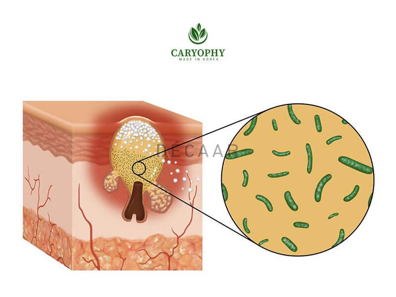 mặt nổi mụn trắng nhỏ